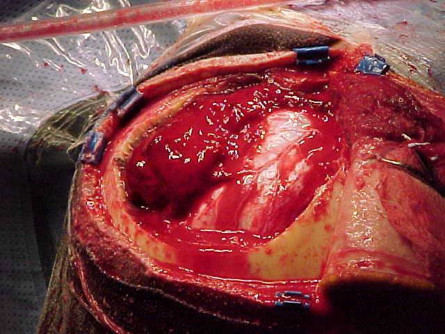 Operative image obtained during emergent craniectomy, showing an exposed cranial surgical field with a large epidural hematoma being evacuated over the cerebral surface. teaching image