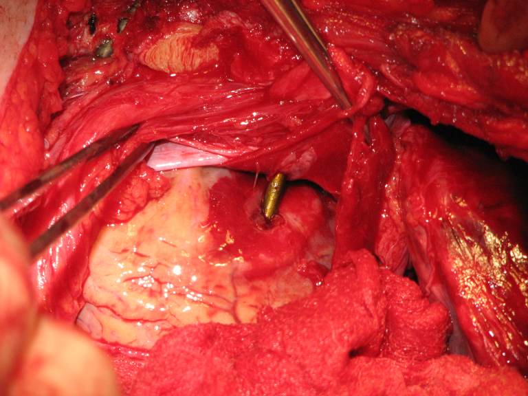 OPERATIVE image: open thoracic exposure showing a retained nail embedded in the heart, with surrounding myocardial injury and surgical instruments exposing the field. The confirmed finding is a nail penetrating the heart; the nail remains in situ during thoracotomy. teaching image