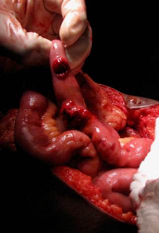 Operative photograph obtained during exploratory laparotomy after abdominal entry, showing exposed small bowel with multiple penetrating injuries and leakage of enteric contents into the operative field. teaching image