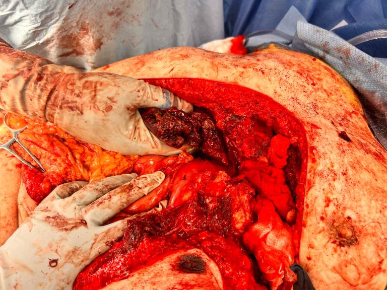 OPERATIVE image: open laparotomy with massive hemoperitoneum and a liver split into two major portions, consistent with catastrophic hepatic transection. teaching image