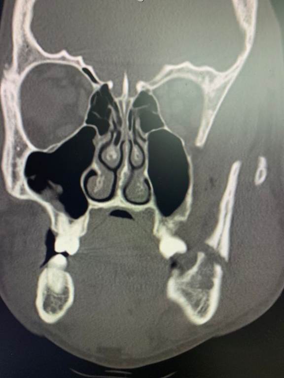 Coronal CT image from diagnostic maxillofacial imaging demonstrating a displaced mandibular fracture involving the left mandibular body/angle region, with adjacent soft-tissue injury. teaching image