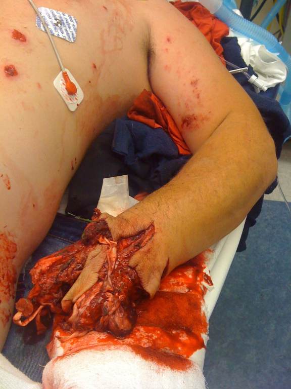External examination photograph obtained by the ED or trauma team in the resuscitation area before definitive operative management. The image shows a severely mangled, contaminated hand with extensive tissue destruction and blood-soaked dressings; exact vascular and skeletal viability cannot be determined from the photograph alone. teaching image