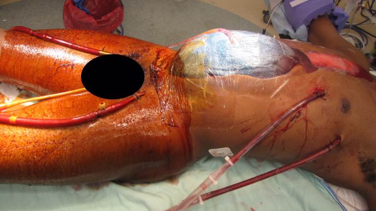 Operative or early postoperative bedside photograph: the patient has a temporary abdominal closure with a visible laparotomy incision and multiple large-bore cannulae or tubing consistent with extracorporeal support. The photograph is classified as OPERATIVE/POSTOPERATIVE ICU documentation rather than diagnostic imaging; the exact ECMO configuration and acquisition timing require clinical-record confirmation. teaching image