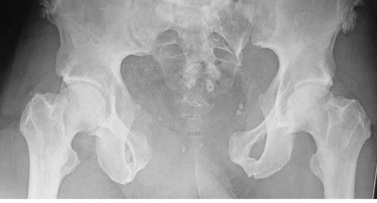 AP anteroposterior pelvic radiograph obtained during initial emergency-department resuscitation shows marked pubic symphysis diastasis with widening of the anterior pelvic ring, consistent with an open-book pelvic ring injury; associated posterior-ring injury must be presumed until excluded. teaching image