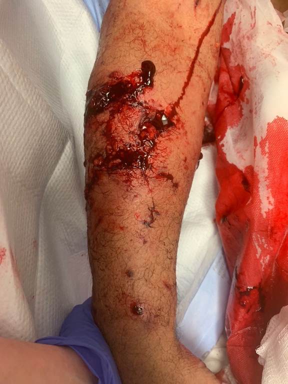 ED external clinical photograph of the right arm showing multiple deep, contaminated puncture-laceration wounds with tissue disruption and blood. The image is an external examination photograph obtained during the initial emergency-department evaluation; it is not a radiograph, CT, or operative image. teaching image