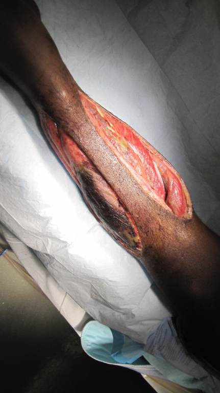 INTRAOPERATIVE image obtained after lower-leg fasciotomy: an open longitudinal operative wound with exposed soft tissue. The photograph confirms a fasciotomy but does not independently establish laterality, the exact compartments released, muscle viability, or the indication for surgery. teaching image