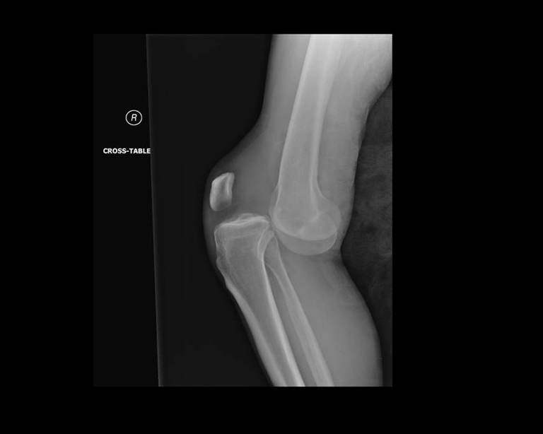 Portable ED cross-table lateral right-knee radiograph obtained after initial trauma stabilization and before reduction, demonstrating posterior tibial displacement relative to the distal femur, consistent with a posterior knee dislocation. The uploaded image is revealed at Stage 1; subsequent vascular findings and CTA occur later in the clinical timeline. teaching image