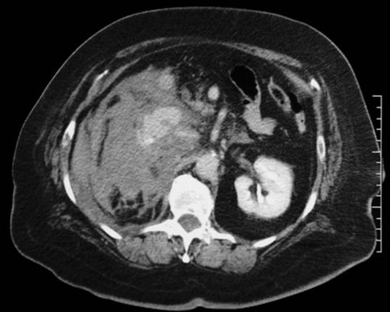 Diagnostic contrast-enhanced axial CT of the abdomen showing a severely disrupted right kidney with extensive perirenal hematoma and active contrast extravasation, consistent with a grade V renal injury; the left kidney enhances normally. teaching image