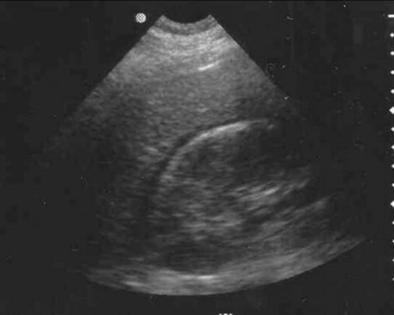 ED/resuscitation ultrasound FAST image demonstrating free intraperitoneal fluid in the right upper-quadrant hepatorenal recess, consistent with a positive FAST. teaching image