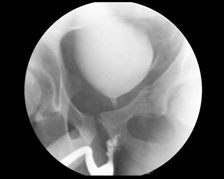 Retrograde urethrogram obtained during ED resuscitation demonstrates posterior urethral contrast extravasation with failure of contrast to enter the bladder, consistent with posterior urethral disruption. teaching image