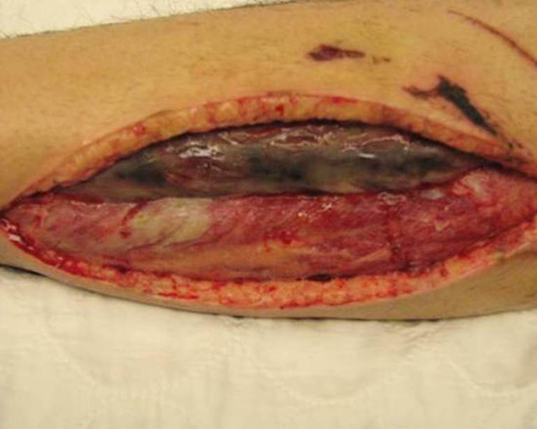 Operative wound photograph acquired during repeat operating-room wound exploration, showing an open fasciotomy wound with dusky-to-black necrotic tissue and nonviable-appearing muscle beneath viable skin margins. teaching image