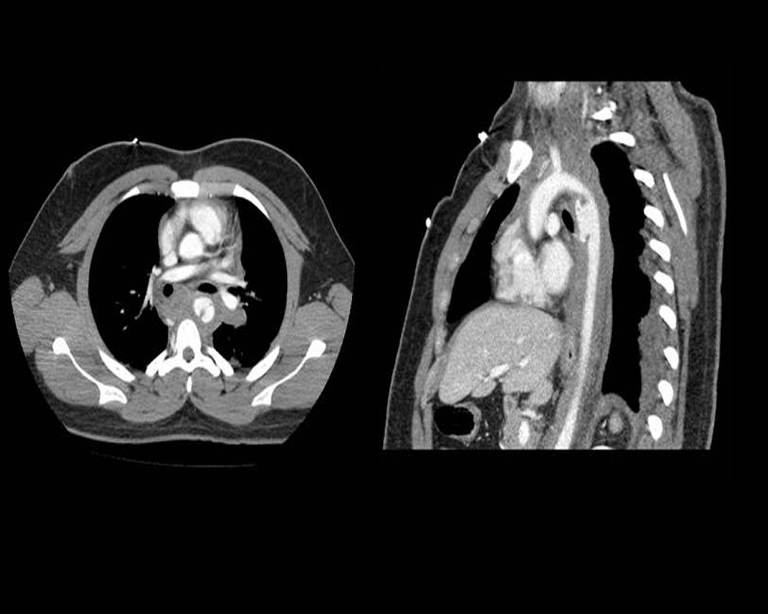 Contrast-enhanced CT angiography of the chest showing the clinician-confirmed traumatic thoracic aortic dissection involving the descending thoracic aorta, with an intimal flap separating true and false lumens. teaching image