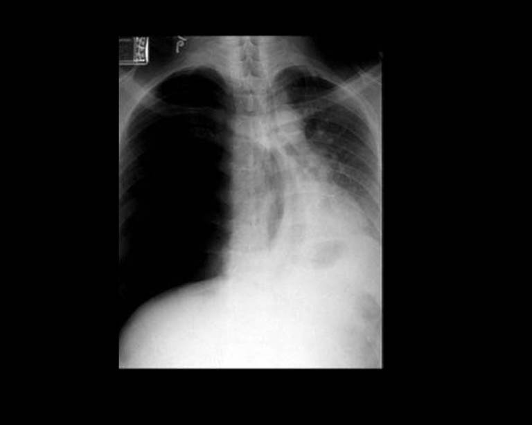 Portable AP chest radiograph obtained during ED resuscitation after initial stabilization, showing a large right pneumothorax with compression of the right lung and leftward mediastinal shift, consistent with tension physiology. teaching image