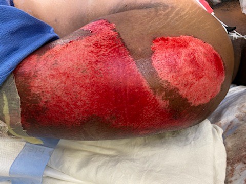 Clinical photograph obtained during the initial ED exposure examination showing broad, contaminated partial-thickness abrasions over the lateral hip and buttock, with denuded erythematous tissue and embedded debris risk. teaching image