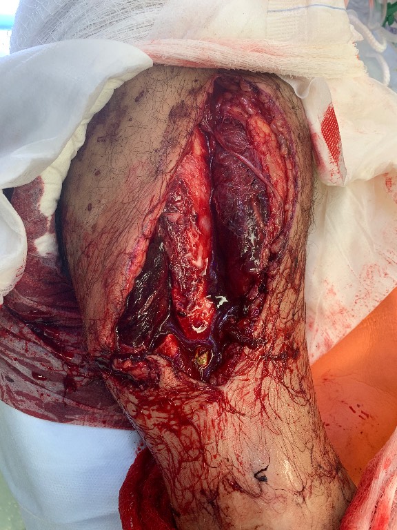 Operative trauma image showing a large, heavily contaminated traumatic wound of the thigh with extensive soft-tissue disruption and exposed injured structures, consistent with the clinician-confirmed severe dirty open-fracture finding. The image is treated as an operative wound photograph obtained after the patient reached the operating room. teaching image