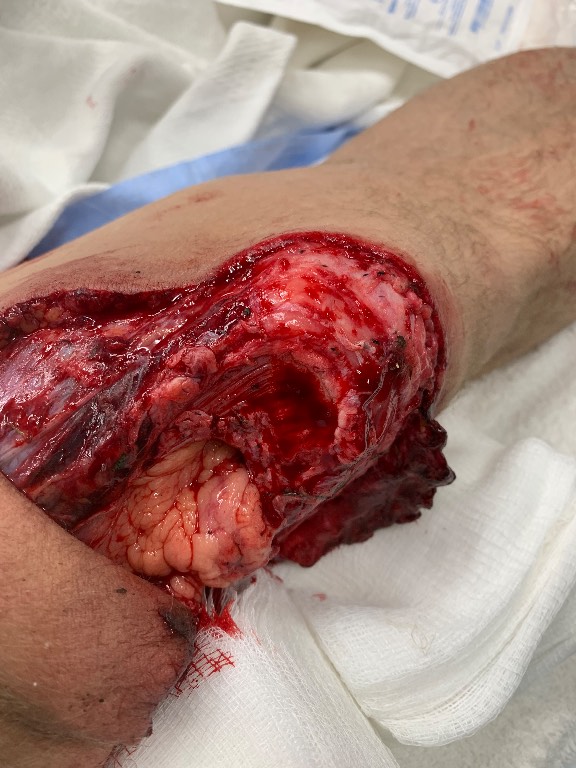 ED/resuscitation external examination photograph obtained after wound exposure during the initial trauma evaluation, showing a grossly contaminated open knee wound with extensive skin and soft-tissue loss, exposed deep structures, and likely communication with the knee joint. The image is available during the initial trauma evaluation. teaching image