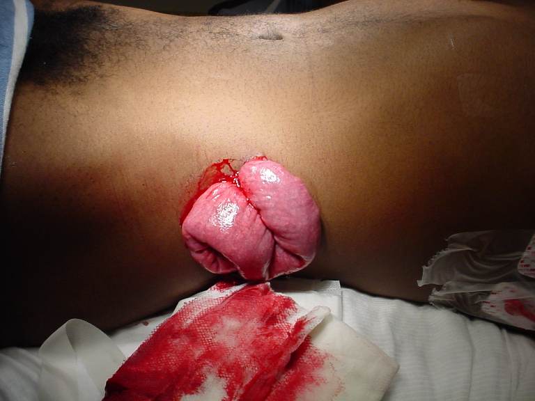 INITIAL TRAUMA-BAY EXTERNAL EXAMINATION image showing exposed bowel protruding through a left flank stab wound; the photograph cannot reliably establish bowel viability, contamination, or the full extent of intra-abdominal injury. teaching image
