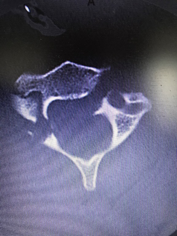 Diagnostic imaging: axial CT bone-window image of the cervical spine demonstrating a cervical fracture extending through the transverse foramen, raising concern for associated vertebral artery injury. The image is noncontrast bony CT; vascular injury requires CTA or equivalent vascular imaging. teaching image
