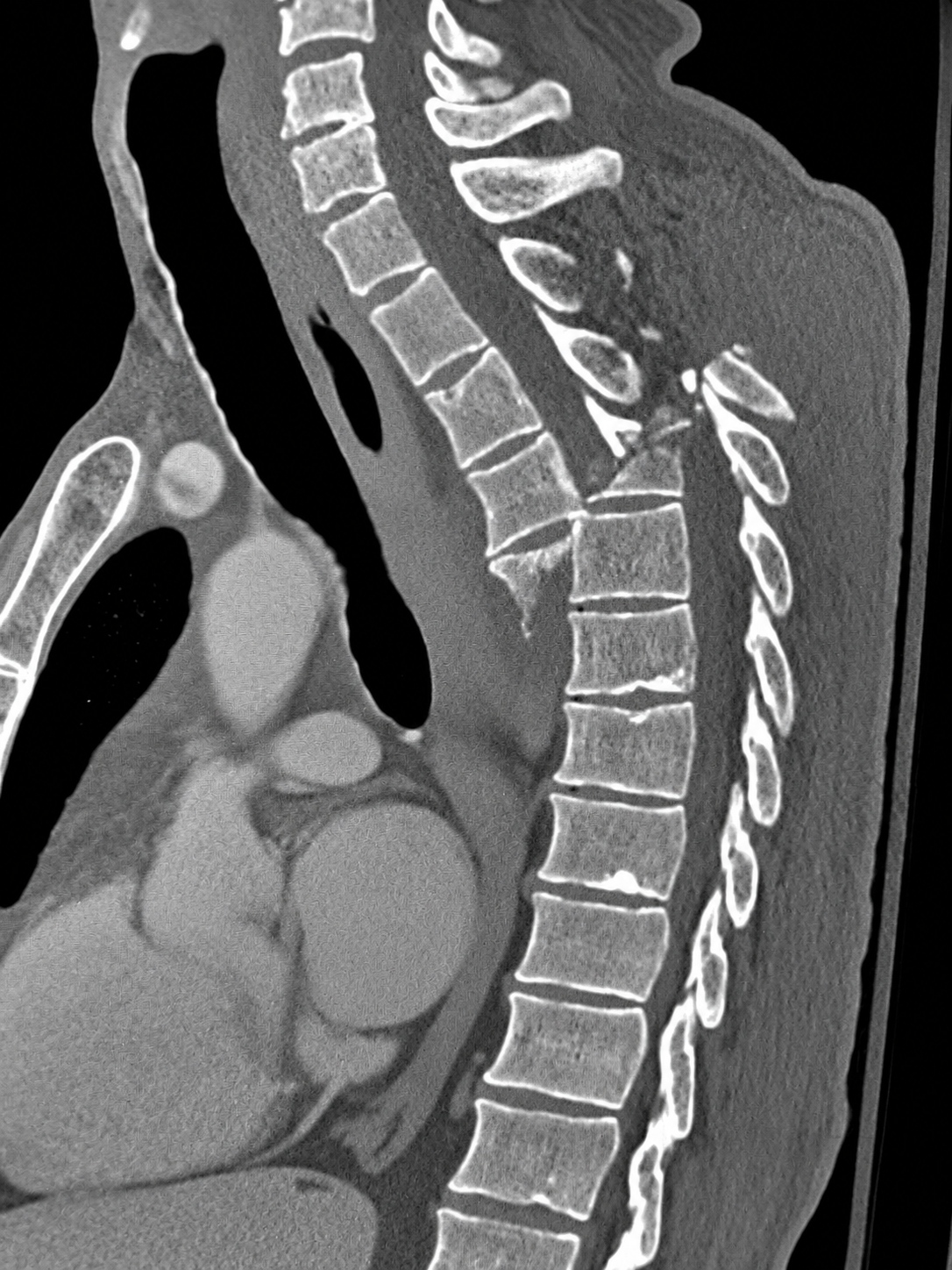 Diagnostic imaging (CT): sagittal cervicothoracic reconstruction demonstrating the clinician-confirmed catastrophic spinal injury with severe disruption and malalignment. Exact fracture classification, levels, canal compromise, and associated injuries require formal review of the complete CT study. teaching image