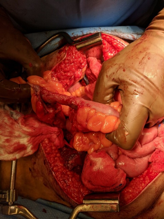 Operative photograph obtained during exploratory laparotomy: a segment of small bowel has relatively preserved-appearing mucosa while the mesentery supplying that segment is extensively disrupted and devascularized, consistent with a bucket-handle injury. teaching image