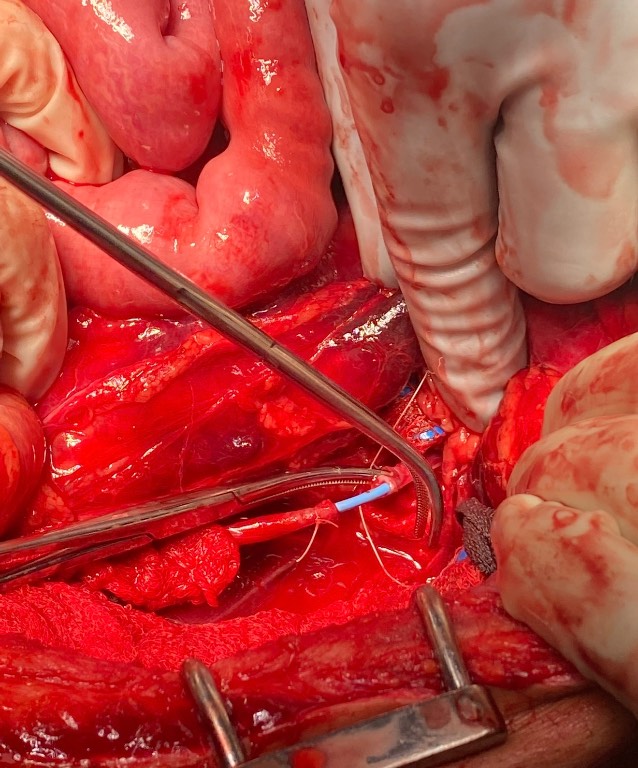 OPERATIVE image: open retroperitoneal exploration demonstrates a transected left ureter undergoing repair over an indwelling ureteral stent, with the operative field retracted for exposure. teaching image