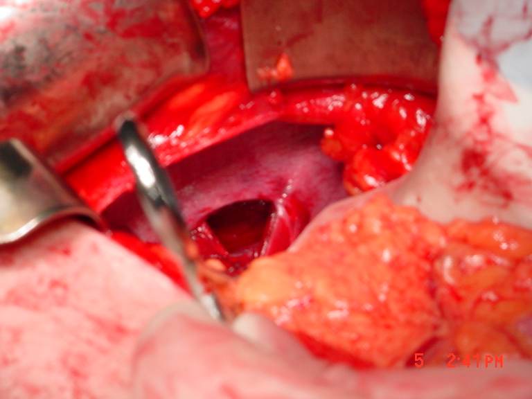 Operative photograph obtained after laparotomy, reduction of herniated contents, and direct exposure of the diaphragm, showing a traumatic full-thickness defect with the thoracic cavity visible through the opening. The image is classified as OPERATIVE. teaching image