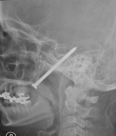 Diagnostic lateral skull/cervical radiograph obtained during the emergency evaluation, showing a retained metallic nail entering through the hard palate with a superior/posterior trajectory toward the skull base; the extent of intracranial and vascular injury requires CT-based evaluation and specialist interpretation. teaching image