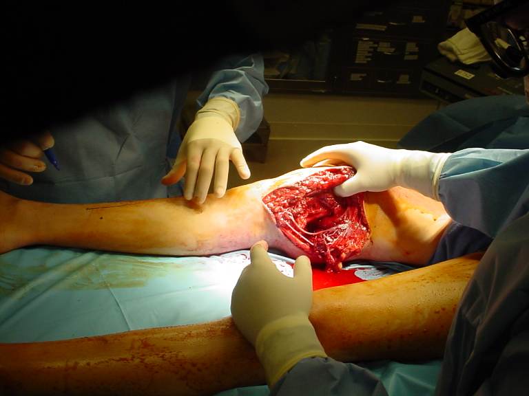 OPERATIVE image obtained during open exploration of the right popliteal fossa, showing extensive traumatic soft-tissue disruption and exposed injured vascular structures. teaching image