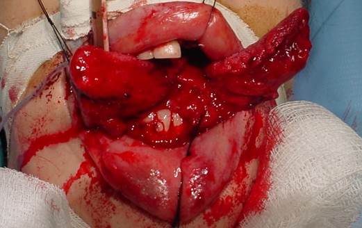 RESUSCITATION-AREA CLINICAL EXAMINATION image: an open-mouth photograph obtained after the patient reached the trauma bay, showing a deep midline tongue laceration extending posteriorly with extensive bleeding and associated facial trauma. teaching image