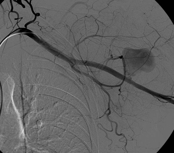 Selective catheter angiography of the upper arm demonstrating active contrast extravasation from a proximal branch vessel, with surrounding vascular opacification and hematoma; the major arterial conduit and distal runoff remain patent. teaching image
