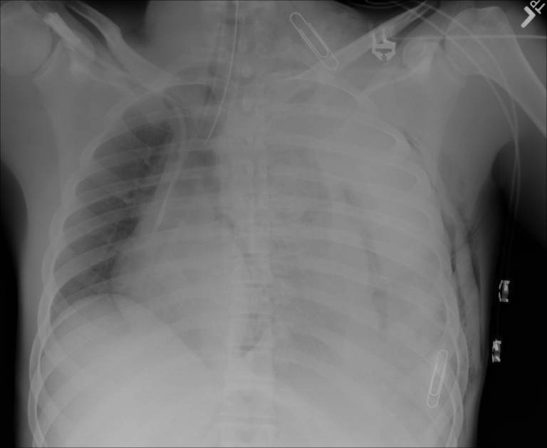 Portable AP supine chest radiograph obtained during ED resuscitation after endotracheal intubation and before chest-tube placement. The image shows near-complete unilateral left hemithorax opacification with apparent mass effect, compatible with a massive traumatic hemothorax in this clinical context; the right lung is comparatively aerated. Confirm image interpretation with the treating trauma team. teaching image