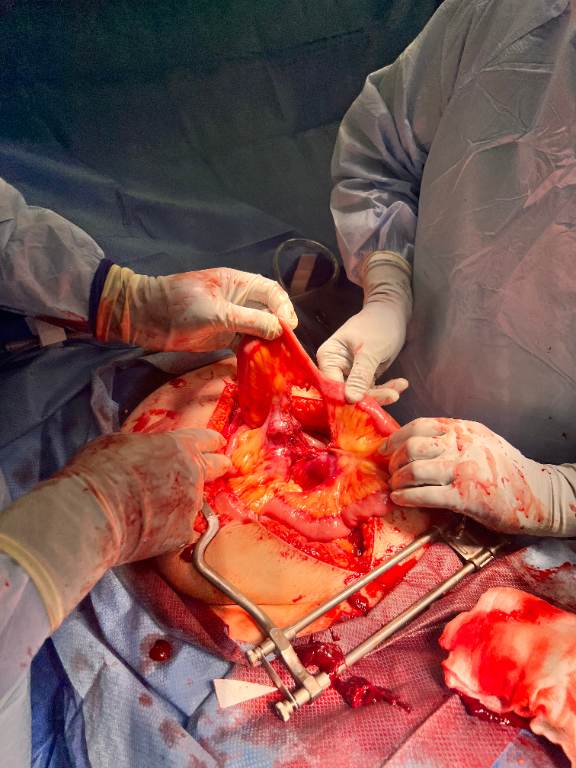 OPERATIVE image acquired after emergency laparotomy: an open abdominal field with a clinician-confirmed traumatic bucket-handle small-bowel/mesenteric injury. The supplied photograph should be interpreted only after the operative pathway has been established. teaching image