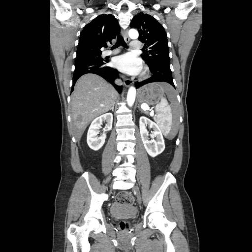 Contrast-enhanced CT abdomen/pelvis with coronal reconstruction: splenic parenchymal injury with reported contrast blush or extravasation and associated perisplenic blood, consistent with the clinician-confirmed splenic injury. teaching image