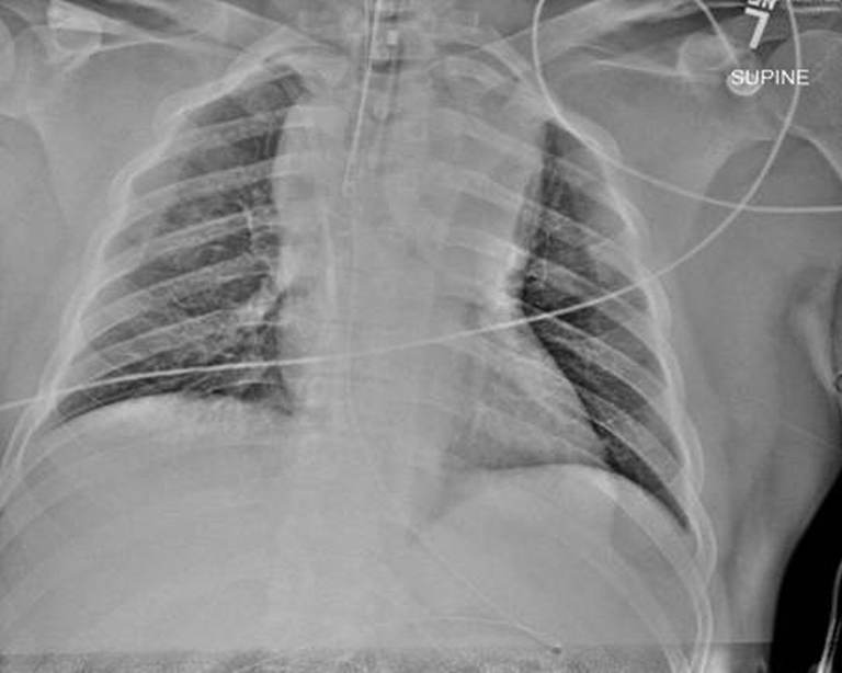 Portable supine AP chest radiograph obtained during initial ED resuscitation after endotracheal intubation. It demonstrates a markedly widened mediastinal silhouette, with the limitations of supine AP technique and rotation considered. teaching image