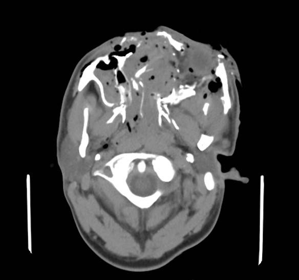 Diagnostic axial facial CT image demonstrating extensive facial and orbital soft-tissue disruption, subcutaneous emphysema, comminuted facial fractures, and retained hyperdense fragments, with severe left orbital injury consistent with the clinician-confirmed complete left eye injury. The image alone does not establish the full extent of globe, vascular, intracranial, or contralateral ocular injury. teaching image
