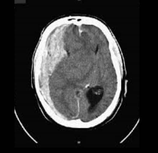 Noncontrast axial head CT obtained after initial ED stabilization shows a large acute right subdural hematoma with substantial mass effect, midline shift, ventricular compression, and compressed basal cisterns, concerning for impending uncal herniation. teaching image