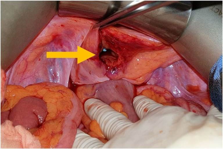 OPERATIVE image: open abdominal exploration shows a focal bladder wall defect at the dome with surrounding traumatic injury, consistent with the clinician-confirmed intraperitoneal bladder rupture. teaching image