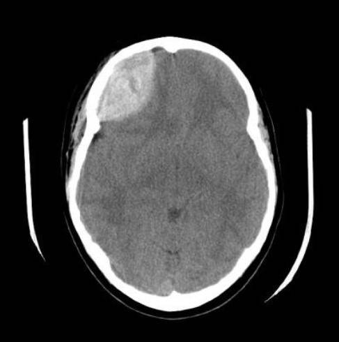 Noncontrast axial head CT demonstrating a right frontal-temporal lentiform extra-axial hyperdensity, consistent with an acute epidural hematoma, with substantial mass effect and midline shift. teaching image