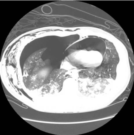 Diagnostic axial CT image demonstrating a large right pneumothorax with mediastinal compression and intrapericardial free air consistent with tension pneumopericardium; associated bilateral pulmonary contusions and chest-wall emphysema are present. teaching image