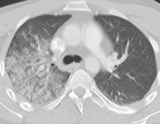 Diagnostic imaging: axial contrast-enhanced chest CT obtained after initial emergency-department resuscitation. The image shows unilateral patchy air-space opacity involving the right lung, consistent with the clinician-confirmed finding of pulmonary contusion; associated rib injury and a small pleural fluid collection may be present but are not the primary teaching finding. teaching image