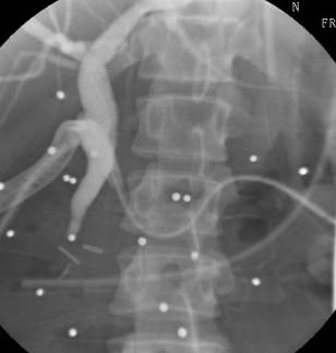 ERCP fluoroscopic cholangiogram obtained several days after damage-control laparotomy, demonstrating contrast opacification of the biliary tree and a rounded radiopaque pellet impacted in the distal common bile duct, with multiple additional retained radiopaque pellets projected over the abdomen. teaching image