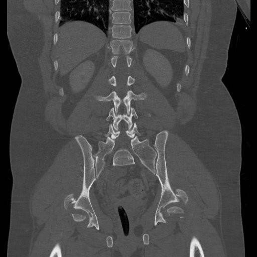 Diagnostic imaging: coronal CT reconstruction of the pelvis demonstrating severe bilateral hip fracture-dislocations with associated acetabular and pelvic fractures. teaching image