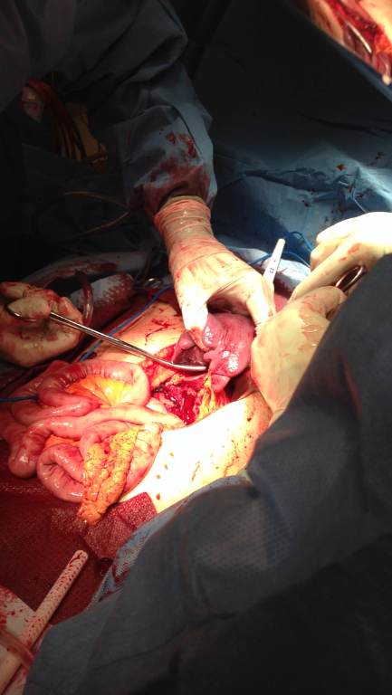 Operative photograph obtained after emergent exploratory laparotomy and abdominal exposure, showing an open abdomen with hemoperitoneum and active left-upper-quadrant bleeding consistent with traumatic splenic injury. teaching image