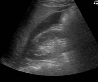 ED/resuscitation ultrasound image acquired during a right-upper-quadrant FAST examination, showing the liver, right kidney, and hepatorenal interface (Morison pouch). The clinician-confirmed finding is that this is the patient's FAST exam in the setting of an initially stable, high-energy motorcycle ejection. teaching image