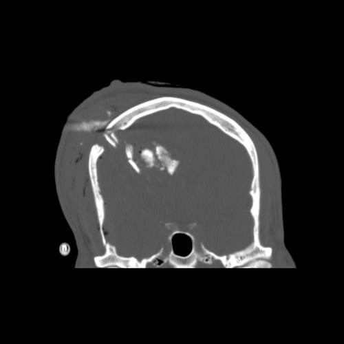 Diagnostic imaging: coronal noncontrast head CT demonstrating the confirmed penetrating gunshot injury with calvarial comminution, intracranial ballistic fragments, and associated traumatic hemorrhagic injury. teaching image
