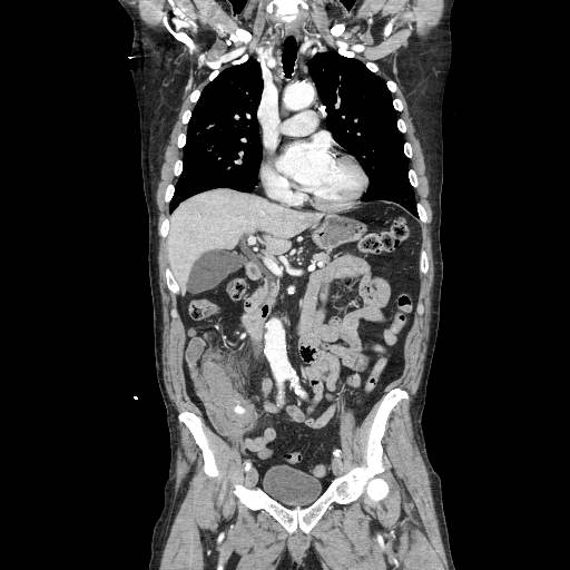 Contrast-enhanced CT of the abdomen and pelvis, represented by a coronal reconstruction, showing active contrast extravasation in the right lower quadrant with adjacent traumatic abdominal or mesenteric change; the image should also be assessed for CT signs of bowel injury, mesenteric disruption, and devascularization. teaching image