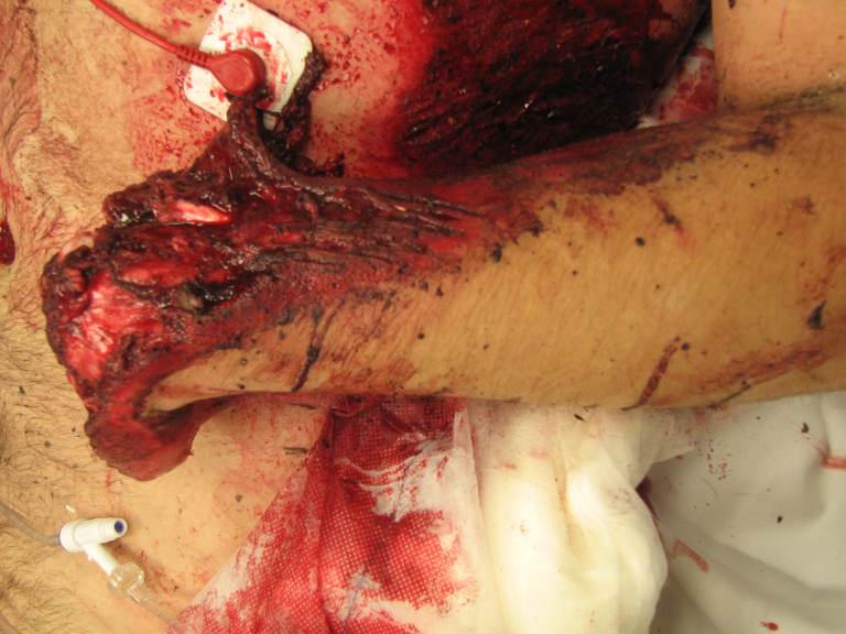 TRAUMA-BAY EXTERNAL-EXAMINATION IMAGE: a severely contaminated, mangled distal forearm and wrist with traumatic hand amputation, extensive soft-tissue loss, exposed and devitalized tissue, and active traumatic bleeding. The image was obtained during initial hemorrhage-control assessment after tourniquet application and before definitive operative management. teaching image