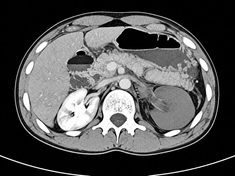DIAGNOSTIC IMAGING (contrast-enhanced CT abdomen): axial image demonstrating traumatic pancreatic-region injury and markedly reduced or absent enhancement of the left kidney, consistent with renal devascularization. teaching image