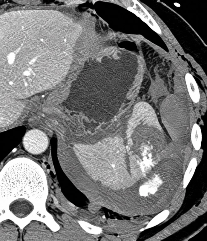 Diagnostic contrast-enhanced CT of the abdomen demonstrating a complex splenic laceration with intraparenchymal and perisplenic high-attenuation foci concerning for active contrast extravasation, with associated hemoperitoneum. teaching image