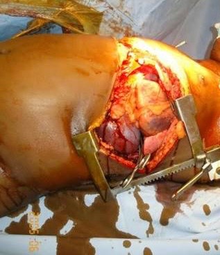 Operative image: an open left anterolateral thoracotomy with rib-spreader exposure of the left hemithorax and bloody intrathoracic operative field. teaching image